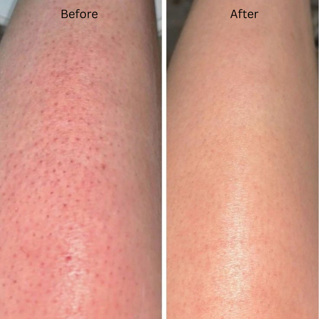 A side-by-side close-up comparison of skin on a forearm, labeled 'Before' on the left and 'After' on the right, showing a reduction in red bumpy pores and smoother skin texture.