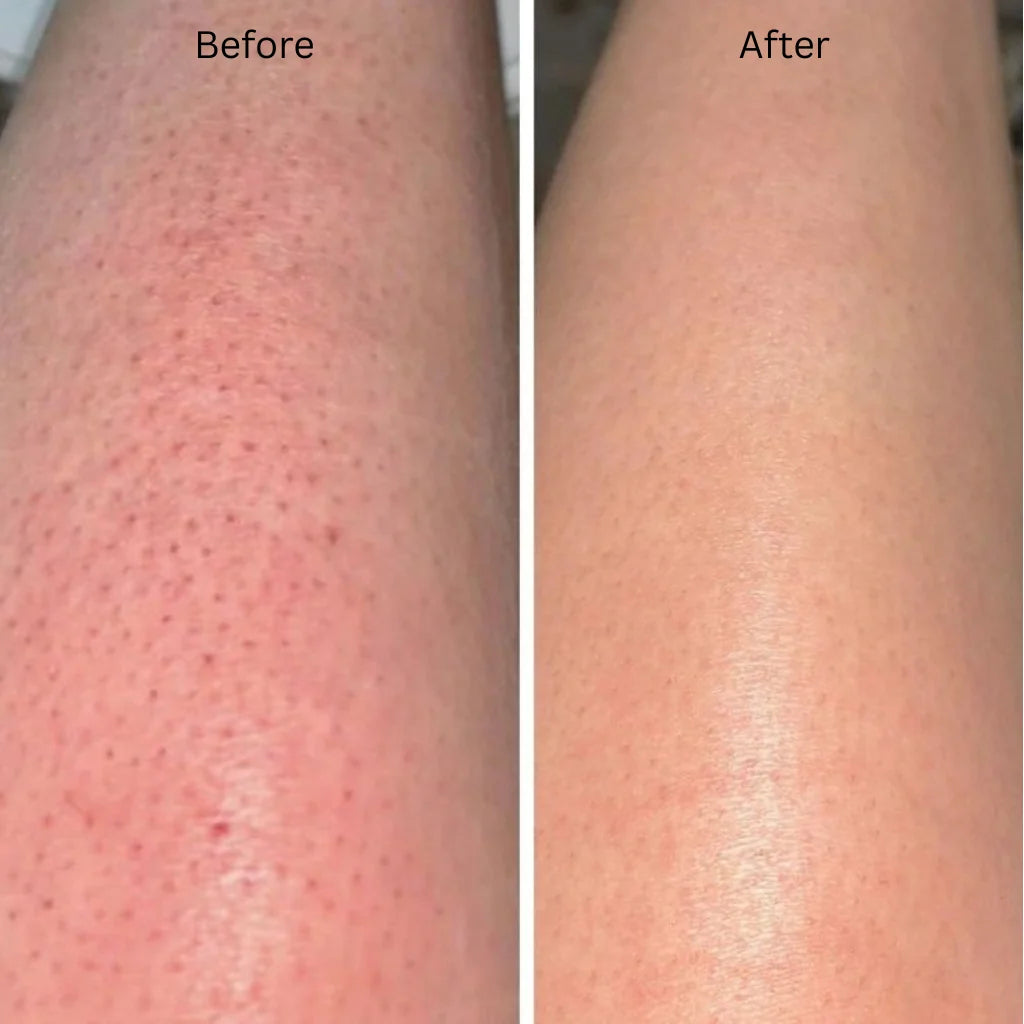 Before and after close-up comparison of skin on an arm, showing a reduction in pore appearance and smoother texture.